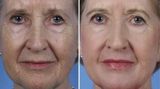 फोटो से पहले और बाद में आंशिक चेहरे का कायाकल्प